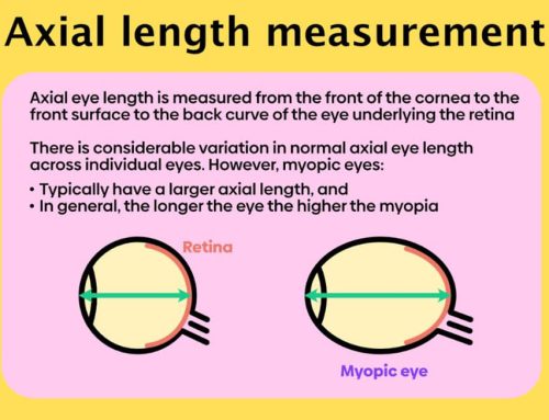 The True Measure of Myopia: Why Axial Length Matters More Than Your Prescription